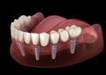 Mandibular prosthesis All on 6 system supported by implants. Medically accurate 3D illustration of human teeth