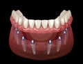 Mandibular prosthesis All on 8 system supported by implants. Medically accurate 3D illustration of human teeth and dentures Royalty Free Stock Photo
