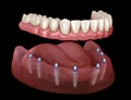 Mandibular prosthesis All on 8 system supported by implants. Medically accurate 3D illustration of human teeth and dentures Royalty Free Stock Photo