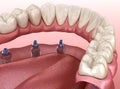 Mandibular prosthesis with gum All on 6 system supported by implants. Medically accurate 3D illustration of human teeth