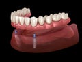 Mandibular removable prosthesis All on 2 system supported by implants with ball attachments. Medically accurate dental Royalty Free Stock Photo