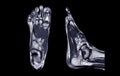 Manetic resonance imaging of foot or MRI FOOT PDW axial, Coronal and sagittal view for diagnostic tendon injury