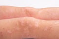 Manifestation of dermatitis on the child body, rash on the legs close-up, redness on the skin, allergic reaction