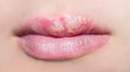 Manifestation of herpes Royalty Free Stock Photo