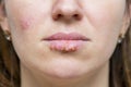 Manifestation of the herpes virus on the lips closeup. Part of a young woman`s face with a virus herpes on lips