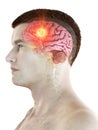 A mans brain tumor Royalty Free Stock Photo