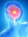 a mans brain tumor Royalty Free Stock Photo