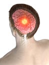 A mans brain tumor Royalty Free Stock Photo