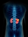 A mans kidney tumor