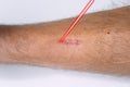 Mans leg and scar laser removal session treatment. Laser resurfacing of scars , laser surgery, skincare.