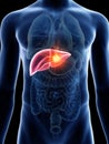 A mans liver cancer Royalty Free Stock Photo