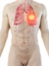 a mans lung tumor Royalty Free Stock Photo