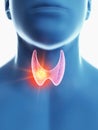 A mans thyroid gland cancer Royalty Free Stock Photo