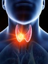 A mans thyroid gland cancer Royalty Free Stock Photo