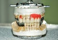 Manufacturing of dental prostheses, metal-ceramic crowns on gypsum teeth models in the treatment of patients by a dentists
