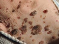 Many mole on the skin of elderly woman