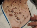 Many mole on the skin of elderly woman