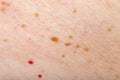 Many nevus and cherry angioma on human skin