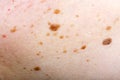 Many nevus on human skin