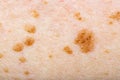 Many nevus on human skin Royalty Free Stock Photo