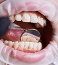 Dentist`s hand checking patient`s lower teeth with a help of mirror.