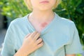 Mark on the skin of chest of eight years old child. Hemangioma is a red birthmark from blood vessels on the skin, benign tumor