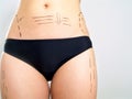 Marked body for cosmetic surgery