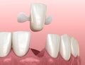 Maryland bridge made from ceramic, front tooth recovery. Medically accurate 3D illustration of dental concept