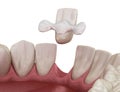 Maryland bridge made from ceramic, front tooth recovery. Medically accurate 3D illustration of dental concept