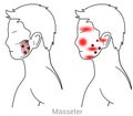 Masseter myofascial trigger point eye, nose, chin, cheek, ear ache and jaw pain