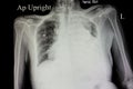 massive pleural effusion