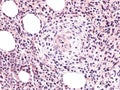 Systemic mastocytosis in bone marrow