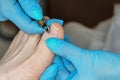 Master chiropody removes cuticle