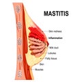 Mastitis. Cross-section of the mammary gland with inflammation o