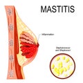 Mastitis. inflammation of the breast abscess formation.