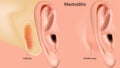 Mastoiditis. Inflammation of the mucosal lining of the mastoid antrum and mastoid air cell system inside the mastoid Royalty Free Stock Photo