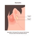 Mastoiditis. Inflammatory disease of the ear. Bacterial mastoid Royalty Free Stock Photo