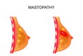 Mastopathy. healthy and diseased mammary gland