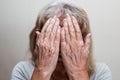 Mature caucasian woman hidden her face with the hands showing problem of vitiligo disorder pigmentation