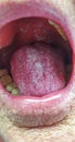 Mature female with oral candidiasis