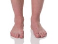 Mature man barefoot with dry skin Royalty Free Stock Photo