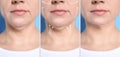 Mature woman before and after plastic surgery operation on blue background. Double chin problem Royalty Free Stock Photo