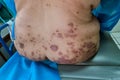 Mature woman with psoriasis in the lower back.