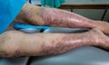 Mature woman with psoriasis in lower extremities