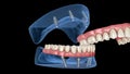 Maxillary and Mandibular prosthesis with gum All on 4 system supported by implants. Medically accurate 3D animation