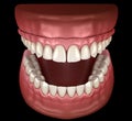 Maxillary and Mandibular prosthesis with gum All on 4 system supported by implants. Medically accurate 3D illustration