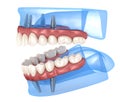 Maxillary and Mandibular prosthesis with gum All on 4 system supported by implants. Medically accurate 3D illustration of human