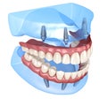 Maxillary and Mandibular prosthesis with gum All on 4 system supported by implants. Medically accurate 3D illustration of human