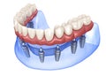 Maxillary and Mandibular prosthesis with gum All on 8 system supported by implants. Medically accurate 3D illustration of human