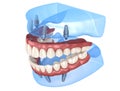 Maxillary and Mandibular prosthesis with gum All on 4 system supported by implants. Medically accurate 3D illustration of human